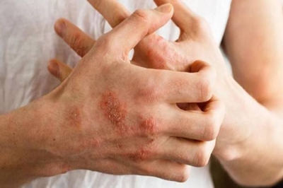 "أطباء" يكشفون عن أفضل الأطعمة التي تخفف من أعراض الأكزيما • صحيفة المرصد