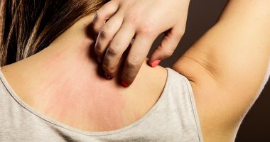 كيف تعرف أن الطفح الجلدي على جسمك ناتج عن جدرى القرود؟