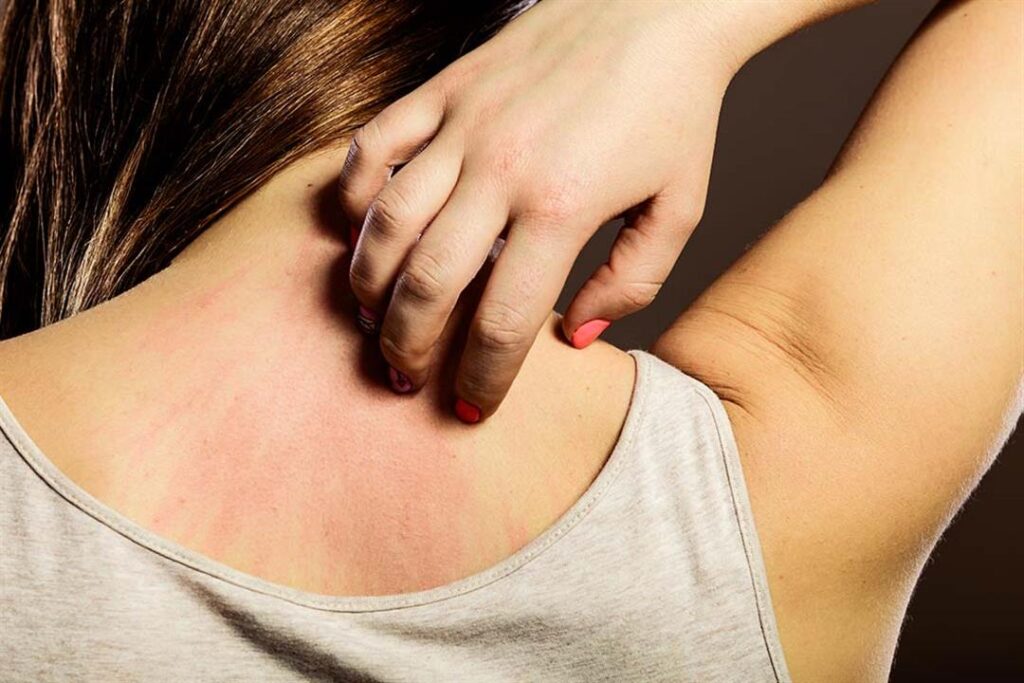4 طرق طبيعية لعلاج حكة الجسم في المنزل.. أبرزها خل التفاح