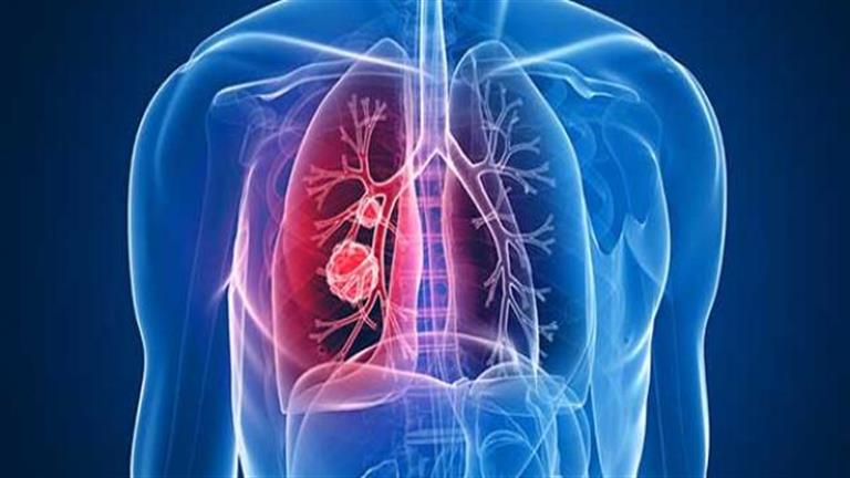 6 علامات تكشف الإصابة بسرطان الرئة.. وفي هذا الوقت توجه فور