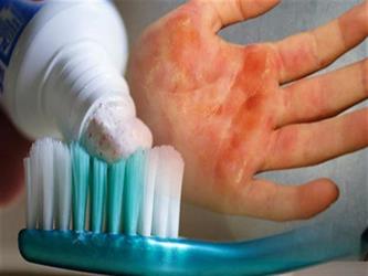 أخبار 24 | الصحة الخليجي: علاج الحروق بمعجون الأسنان شائعة.. وهذه طريقة العلاج الصحيحة