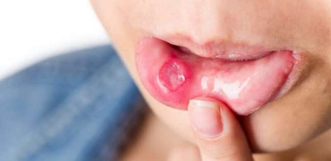 علاج قرح الفم في المنزل- صورة تعبيرية