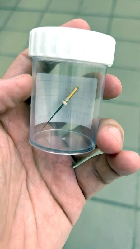 التحقيق في ابتلاع شاب أداة سحب عصب أسنان ! - أخبار السعودية