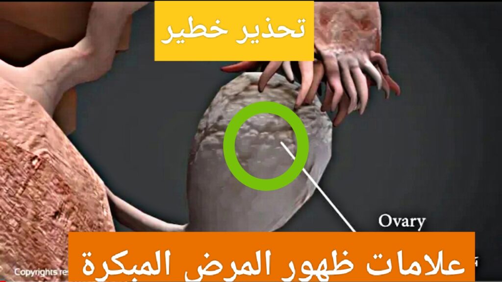 "القاتل الصامت".. تحذير من هذا المرض الخطير يصيب المرأة وظهور العلامات متأخر تعرفي عليه