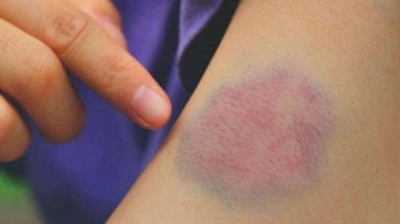 الكشف عن 5 أطعمة "تمنع الدم من الحركة" وتسبب جلطات دموية خطيرة • صحيفة المرصد