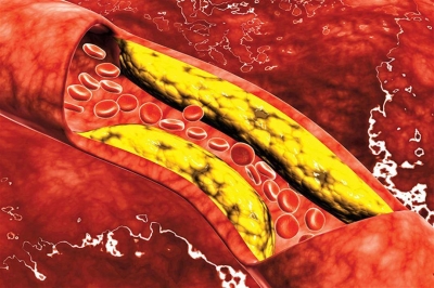 الكشف عن علامات تحذيرية تشير لارتفاع الكولسترول في الدم • صحيفة المرصد