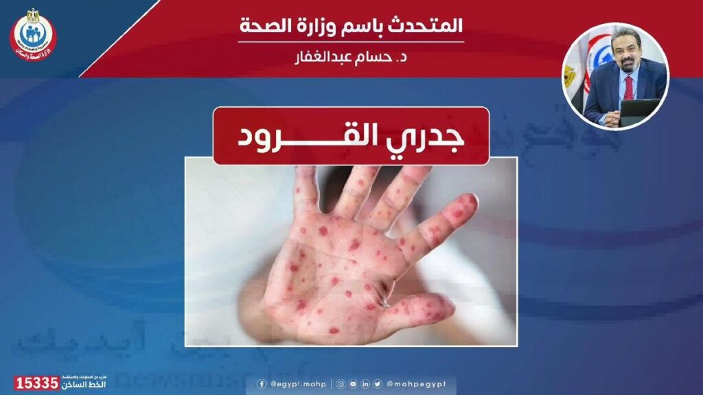 بعد عزل أول حالة مصابة في مصر.. ما هي أعراض جدري القرود وكيف يتم علاجه؟