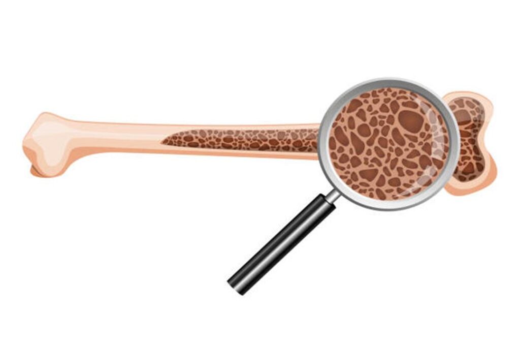 علاج هشاشة العظام طبيعيًا- 3 طرق منزلية تستحق التجربة