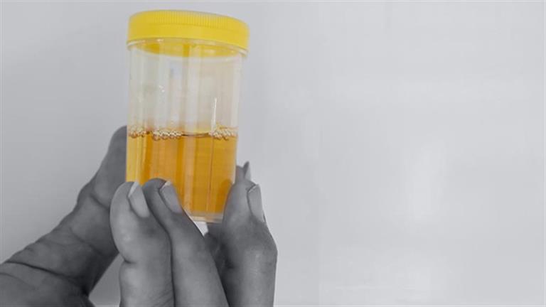 للرجل.. نزول هذا السائل مع البول يشير لأمراض خطيرة