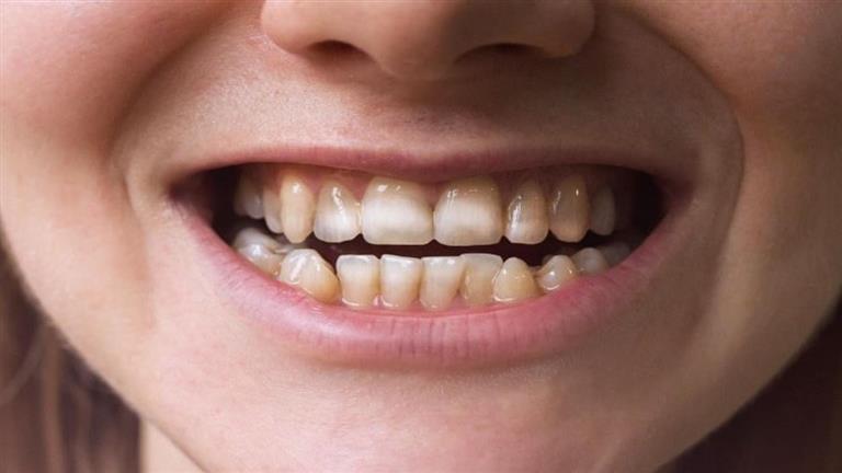 ما العلاقة بين الأسنان ومشكلات المعدة؟