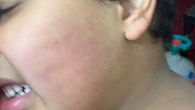 تفاصيل تعرض طفل متوحد لإيذاء جسدي على يد وافدة.. وأول إجراء من شرطة عسير