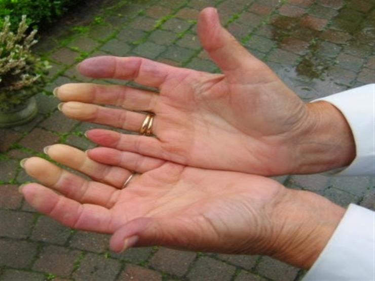تنميل الأصابع من أعراض نقص هذا الفيتامين.. كيف تعالجه؟