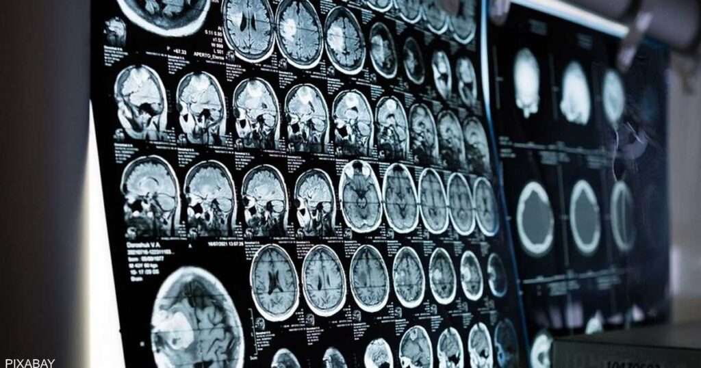 عارض ليلي تتعرض له النساء.. مؤشر على الإصابة بسكتة دماغية