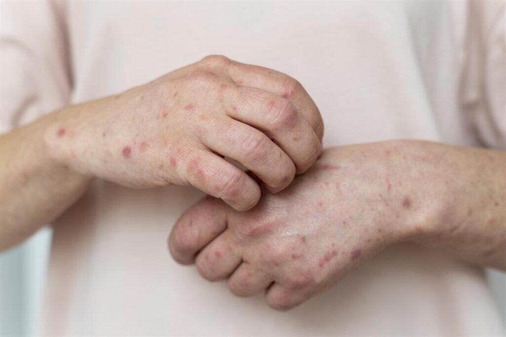 قبل أربع أيام من ظهور أعراضه.. مفاجأة بشأن انتشار جدري الق